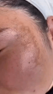 Fast Acting Organic Skin Tag Removal Serum