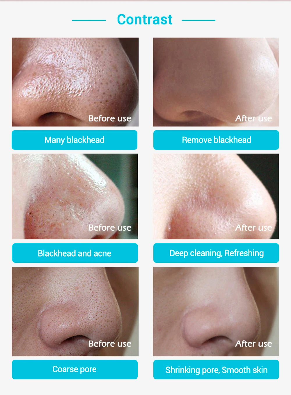  DermaStrips™ - 60PCS Blackhead/Whitehead Pore Strips