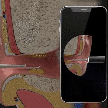 Smart Otocam Ear Cleaning Tool with HD Camera
